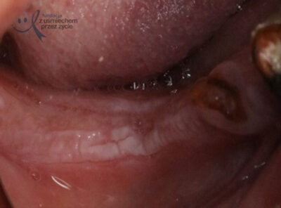 Nadmierne rogowacenie części zębodołowej żuchwy 2