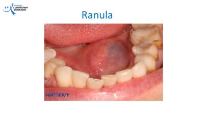 Zmiany, które widzi lekarz dentysta, dr Hanna Chaciewicz, Fundacja z uśmiechem przez życie (10)