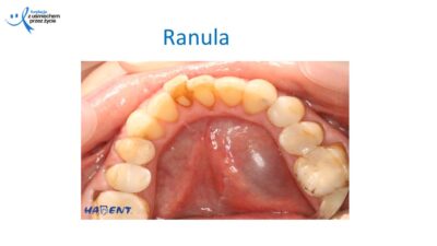 Zmiany, które widzi lekarz dentysta, dr Hanna Chaciewicz, Fundacja z uśmiechem przez życie (11)