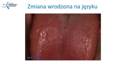 Zmiany, które widzi lekarz dentysta, dr Hanna Chaciewicz, Fundacja z uśmiechem przez życie (15)