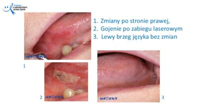 Zmiany, które widzi lekarz dentysta, dr Hanna Chaciewicz, Fundacja z uśmiechem przez życie (16)