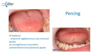 Zmiany, które widzi lekarz dentysta, dr Hanna Chaciewicz, Fundacja z uśmiechem przez życie (18)