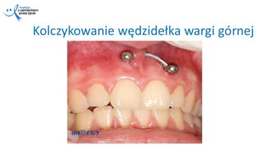 Zmiany, które widzi lekarz dentysta, dr Hanna Chaciewicz, Fundacja z uśmiechem przez życie (19)