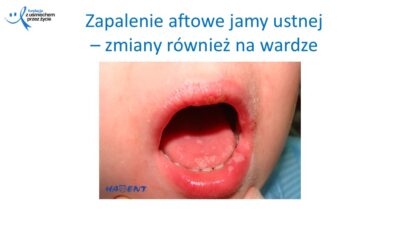 Zmiany, które widzi lekarz dentysta, dr Hanna Chaciewicz, Fundacja z uśmiechem przez życie (20)