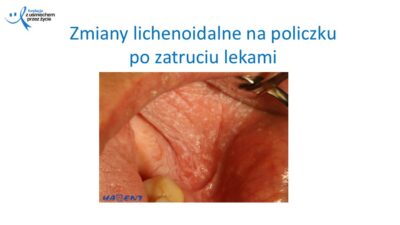 Zmiany, które widzi lekarz dentysta, dr Hanna Chaciewicz, Fundacja z uśmiechem przez życie (26)