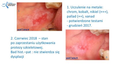 Zmiany, które widzi lekarz dentysta, dr Hanna Chaciewicz, Fundacja z uśmiechem przez życie (28)