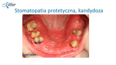 Zmiany, które widzi lekarz dentysta, dr Hanna Chaciewicz, Fundacja z uśmiechem przez życie (30)