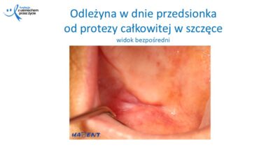 Zmiany, które widzi lekarz dentysta, dr Hanna Chaciewicz, Fundacja z uśmiechem przez życie (33)