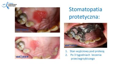 Zmiany, które widzi lekarz dentysta, dr Hanna Chaciewicz, Fundacja z uśmiechem przez życie (35)