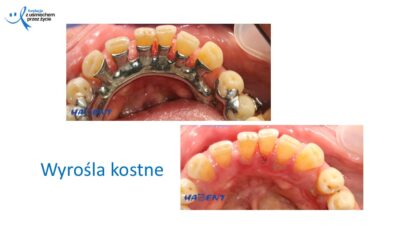 Zmiany, które widzi lekarz dentysta, dr Hanna Chaciewicz, Fundacja z uśmiechem przez życie (36)