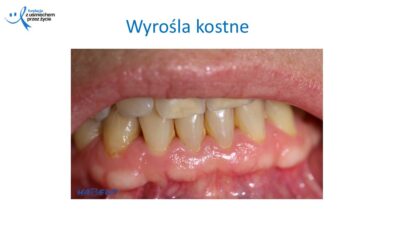 Zmiany, które widzi lekarz dentysta, dr Hanna Chaciewicz, Fundacja z uśmiechem przez życie (37)