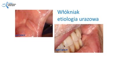 Zmiany, które widzi lekarz dentysta, dr Hanna Chaciewicz, Fundacja z uśmiechem przez życie (39)