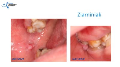 Zmiany, które widzi lekarz dentysta, dr Hanna Chaciewicz, Fundacja z uśmiechem przez życie (41)