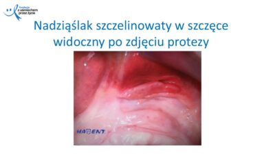 Zmiany, które widzi lekarz dentysta, dr Hanna Chaciewicz, Fundacja z uśmiechem przez życie (43)