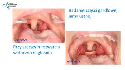 Zmiany, które widzi lekarz dentysta, dr Hanna Chaciewicz, Fundacja z uśmiechem przez życie (49)