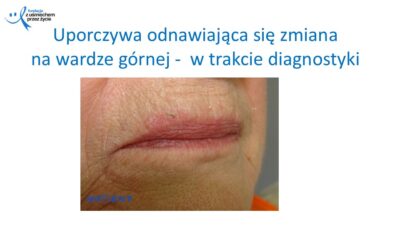 Zmiany, które widzi lekarz dentysta, dr Hanna Chaciewicz, Fundacja z uśmiechem przez życie (5)