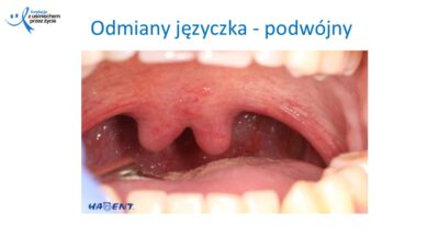 Zmiany, które widzi lekarz dentysta, dr Hanna Chaciewicz, Fundacja z uśmiechem przez życie (50)