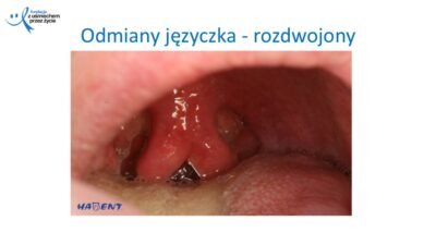 Zmiany, które widzi lekarz dentysta, dr Hanna Chaciewicz, Fundacja z uśmiechem przez życie (51)