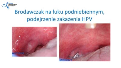 Zmiany, które widzi lekarz dentysta, dr Hanna Chaciewicz, Fundacja z uśmiechem przez życie (52)