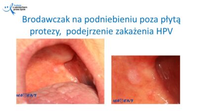 Zmiany, które widzi lekarz dentysta, dr Hanna Chaciewicz, Fundacja z uśmiechem przez życie (54)