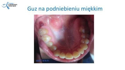 Zmiany, które widzi lekarz dentysta, dr Hanna Chaciewicz, Fundacja z uśmiechem przez życie (56)