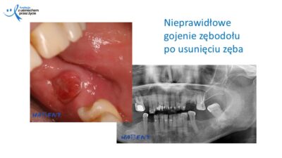 Zmiany, które widzi lekarz dentysta, dr Hanna Chaciewicz, Fundacja z uśmiechem przez życie (57)