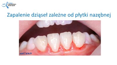 Zmiany, które widzi lekarz dentysta, dr Hanna Chaciewicz, Fundacja z uśmiechem przez życie (60)