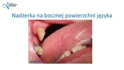 Zmiany, które widzi lekarz dentysta, dr Hanna Chaciewicz, Fundacja z uśmiechem przez życie (61)