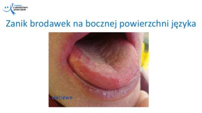 Zmiany, które widzi lekarz dentysta, dr Hanna Chaciewicz, Fundacja z uśmiechem przez życie (62)