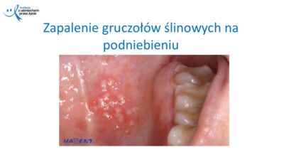 Zmiany, które widzi lekarz dentysta, dr Hanna Chaciewicz, Fundacja z uśmiechem przez życie (63)