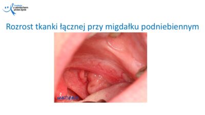 Zmiany, które widzi lekarz dentysta, dr Hanna Chaciewicz, Fundacja z uśmiechem przez życie (65)