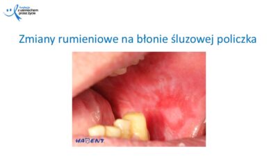 Zmiany, które widzi lekarz dentysta, dr Hanna Chaciewicz, Fundacja z uśmiechem przez życie (66)