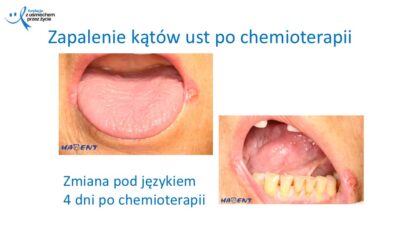 Zmiany, które widzi lekarz dentysta, dr Hanna Chaciewicz, Fundacja z uśmiechem przez życie (9)