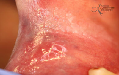 leukoplakia okolicy kątów 2