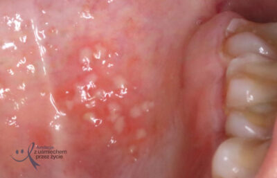 zapalenie gruczołów ślinowych na podniebieniu